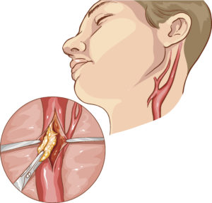 vector illustration of a Carotid Endarterectomy