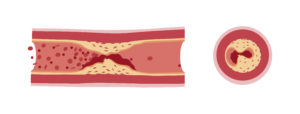 Thrombose